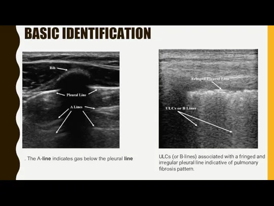 BASIC IDENTIFICATION . The A-line indicates gas below the pleural line