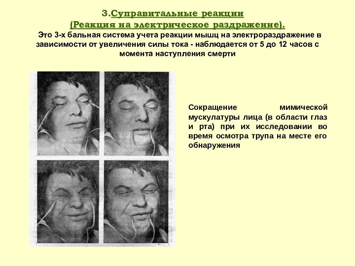 Суправитальные реакции (Реакция на электрическое раздражение). Это 3-х бальная система учета