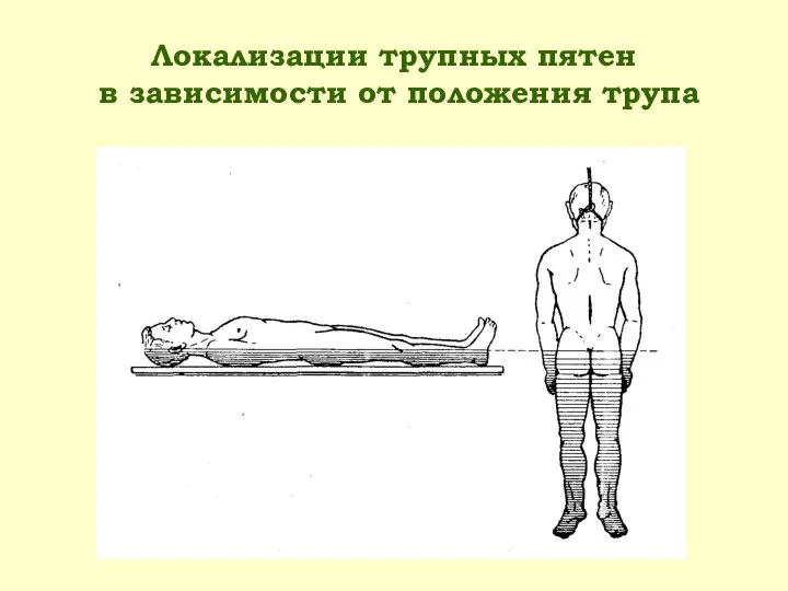 Локализации трупных пятен в зависимости от положения трупа