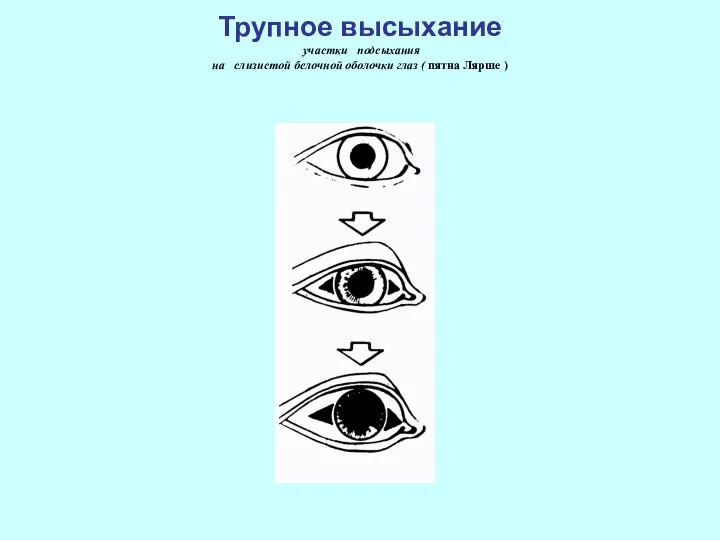 Трупное высыхание участки подсыхания на слизистой белочной оболочки глаз ( пятна Лярше )