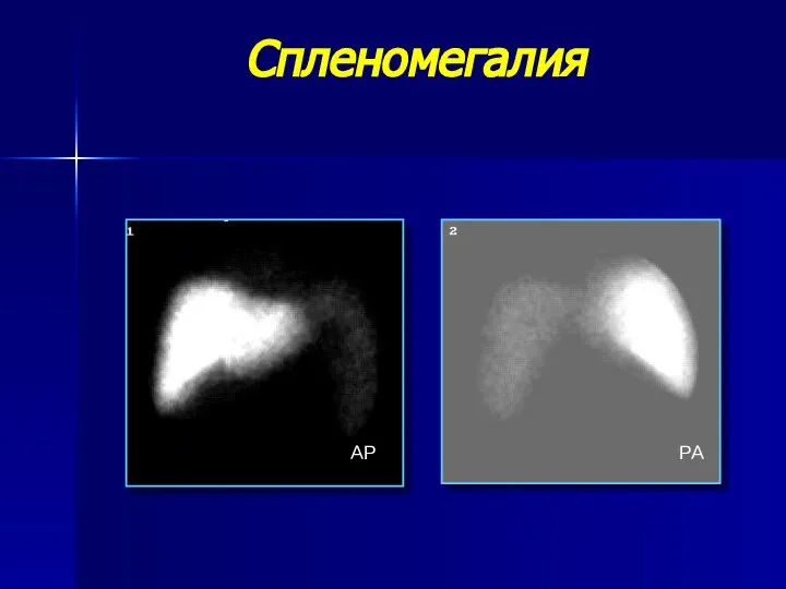 Спленомегалия AP PA