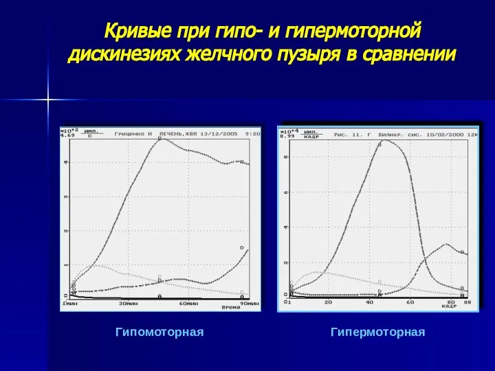 Кривые при гипо- и гипермоторной дискинезиях желчного пузыря в сравнении Гипомоторная Гипермоторная