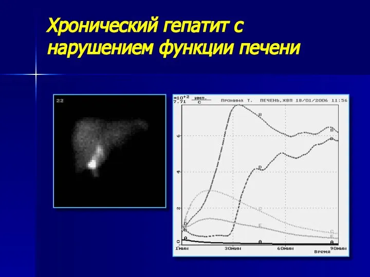 Хронический гепатит с нарушением функции печени