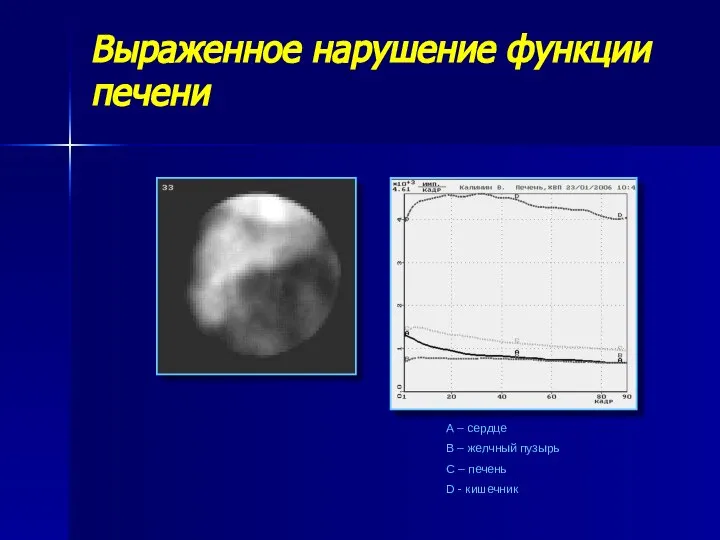 Выраженное нарушение функции печени А – сердце В – желчный пузырь