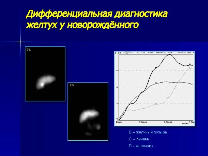 Дифференциальная диагностика желтух у новорождённого B – желчный пузырь C – печень D - кишечник