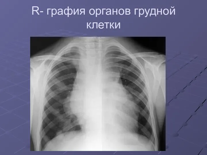 R- графия органов грудной клетки