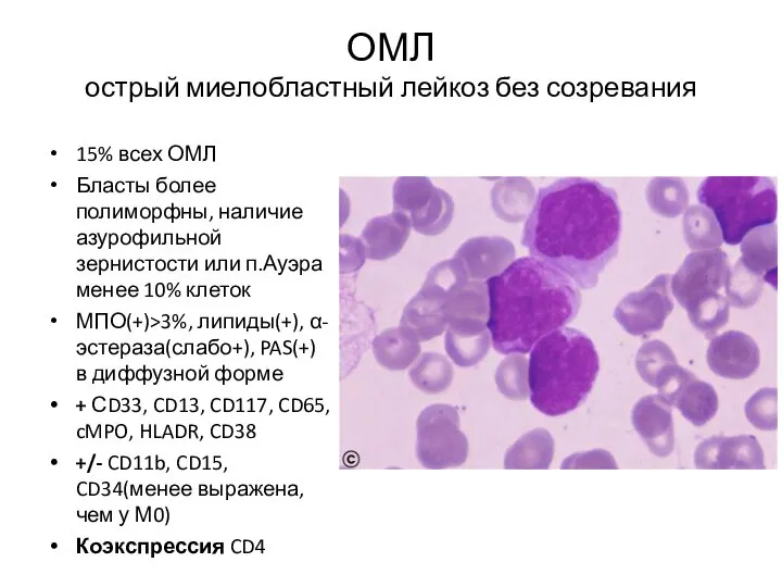 ОМЛ острый миелобластный лейкоз без созревания 15% всех ОМЛ Бласты более