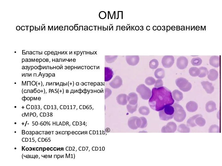 ОМЛ острый миелобластный лейкоз с созреванием Бласты средних и крупных размеров,