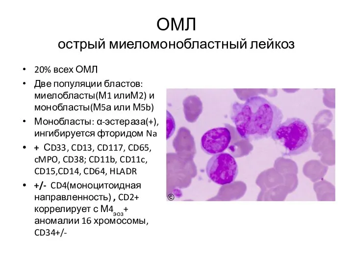 ОМЛ острый миеломонобластный лейкоз 20% всех ОМЛ Две популяции бластов: миелобласты(М1