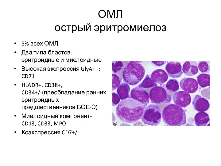 ОМЛ острый эритромиелоз 5% всех ОМЛ Два типа бластов: эритроидные и