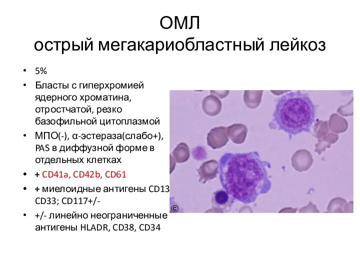 ОМЛ острый мегакариобластный лейкоз 5% Бласты с гиперхромией ядерного хроматина, отростчатой,