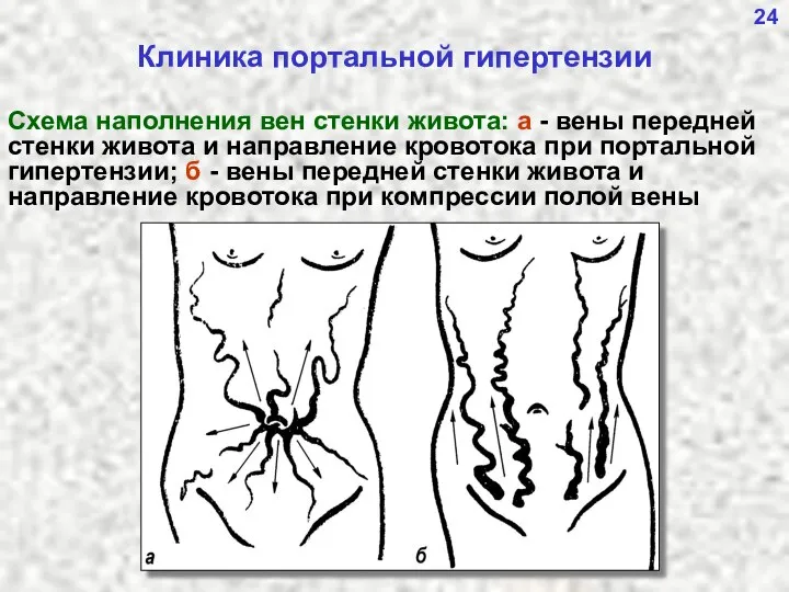 24 Клиника портальной гипертензии Схема наполнения вен стенки живота: а -