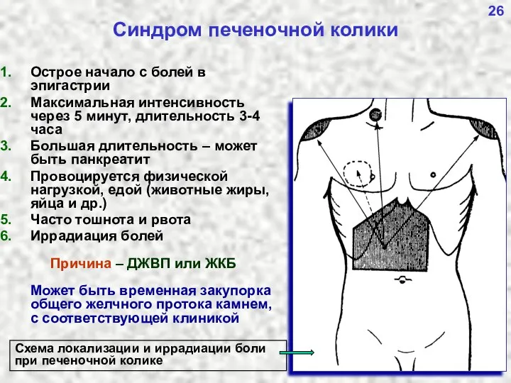 26 Синдром печеночной колики Схема локализации и иррадиации боли при печеночной