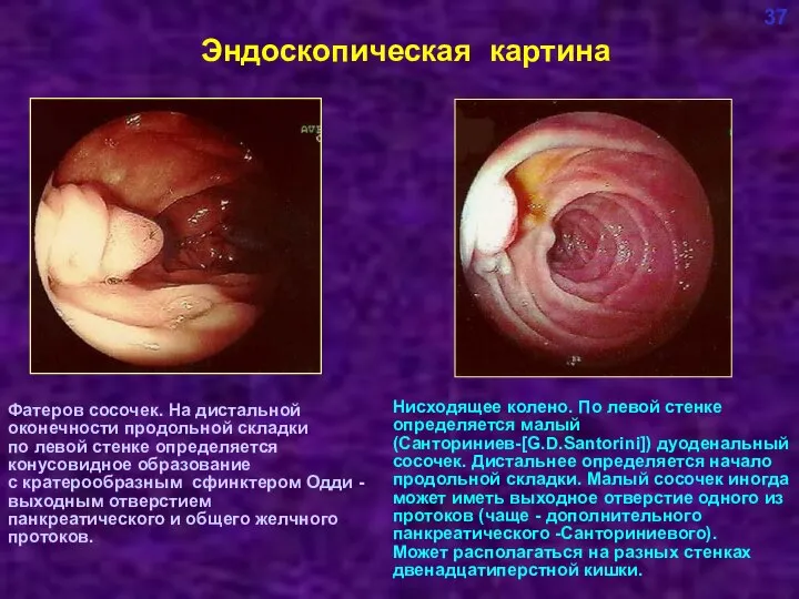 Эндоскопическая картина 37 Нисходящее колено. По левой стенке определяется малый (Санториниев-[G.D.Santorini])