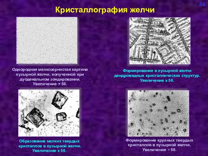 Кристаллография желчи 44 Однородная мелкозернистая картина пузырной желчи, полученной при дуоденальном