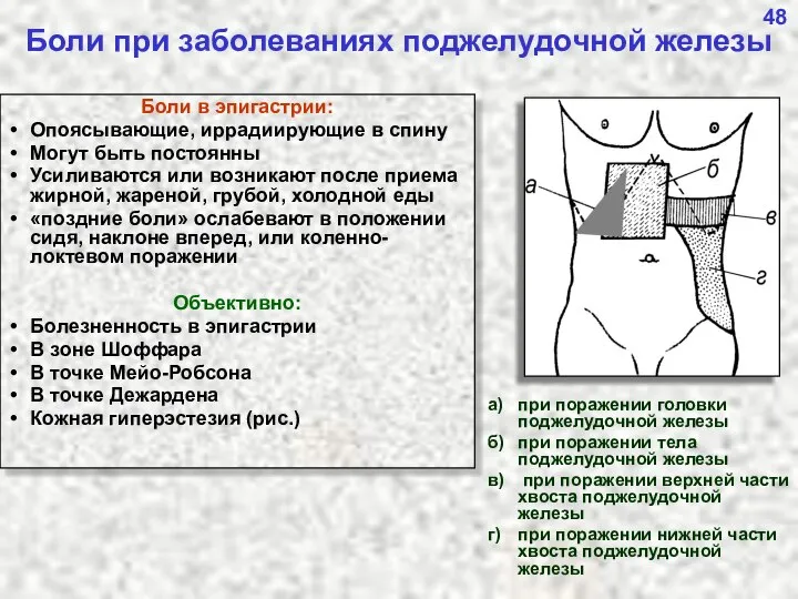 48 Боли при заболеваниях поджелудочной железы а) при поражении головки поджелудочной
