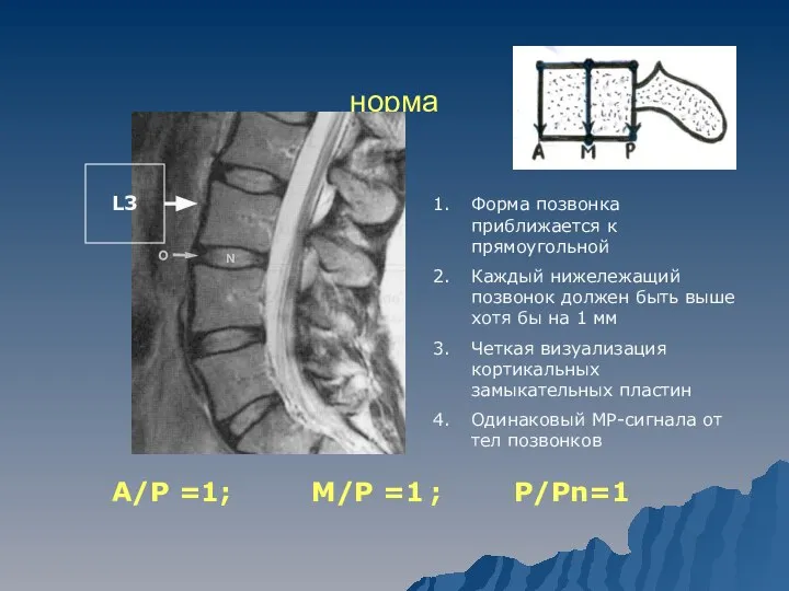 норма А/Р =1; М/Р =1 ; Р/Рn=1 L3 Форма позвонка приближается