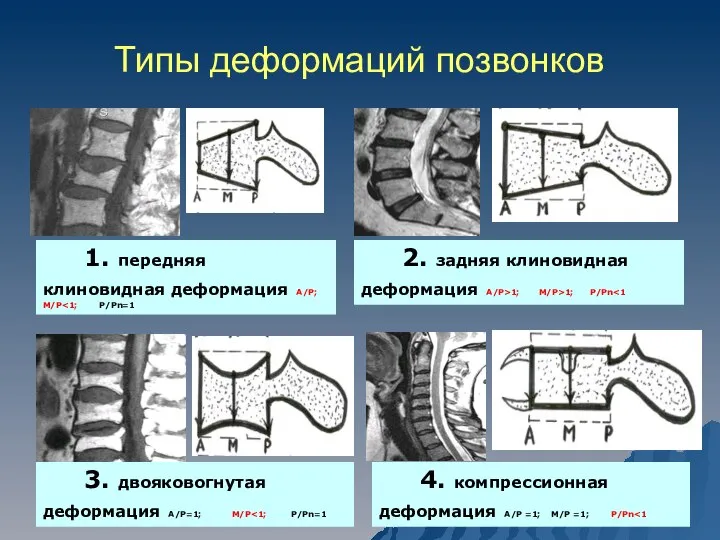 Типы деформаций позвонков 1. передняя клиновидная деформация А/Р; М/Р 2. задняя