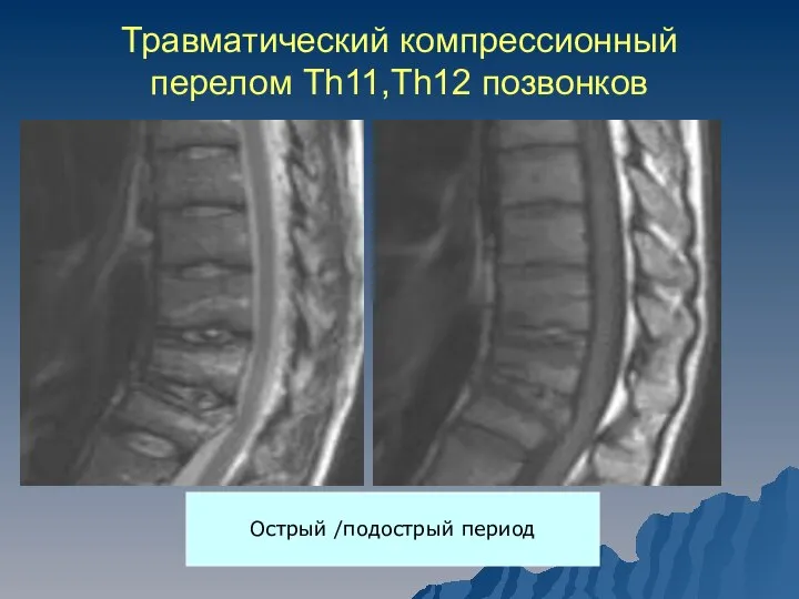 Травматический компрессионный перелом Th11,Th12 позвонков Острый /подострый период