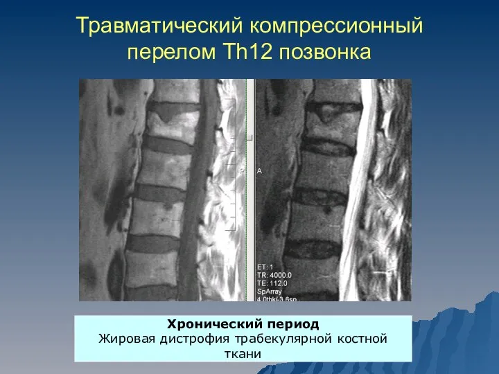 Травматический компрессионный перелом Th12 позвонка Хронический период Жировая дистрофия трабекулярной костной ткани
