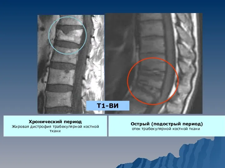Острый (подострый период) отек трабекулярной костной ткани) Т1-ВИ Хронический период Жировая дистрофия трабекулярной костной ткани