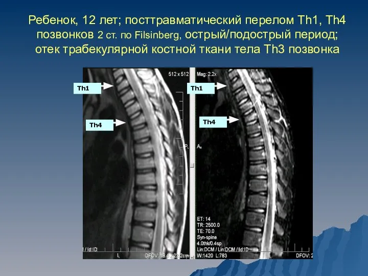 Ребенок, 12 лет; посттравматический перелом Th1, Th4 позвонков 2 ст. по