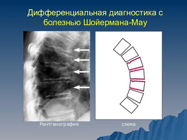 Дифференциальная диагностика с болезнью Шойермана-Мау Рентгенография схема