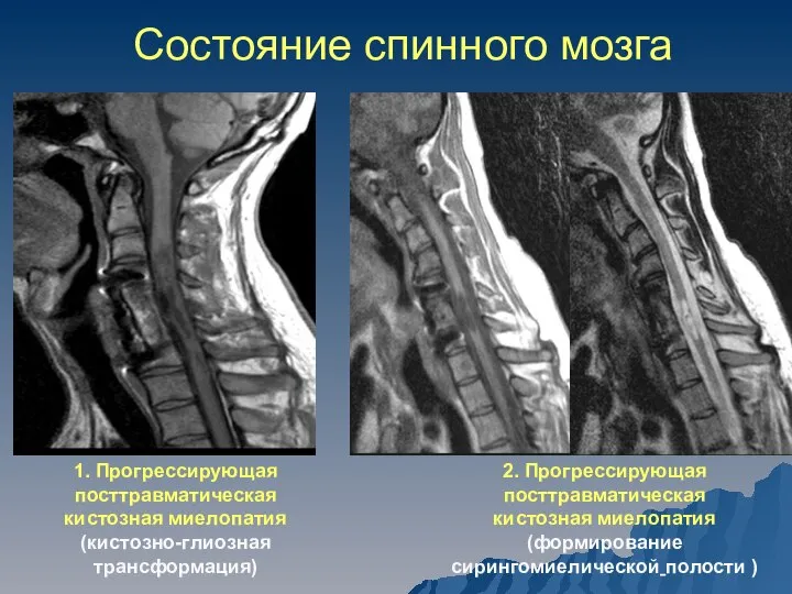 Состояние спинного мозга 1. Прогрессирующая посттравматическая кистозная миелопатия (кистозно-глиозная трансформация) 2.