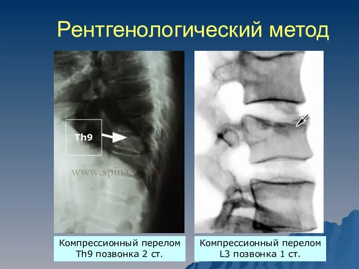 Рентгенологический метод Компрессионный перелом Th9 позвонка 2 ст. Компрессионный перелом L3 позвонка 1 ст.
