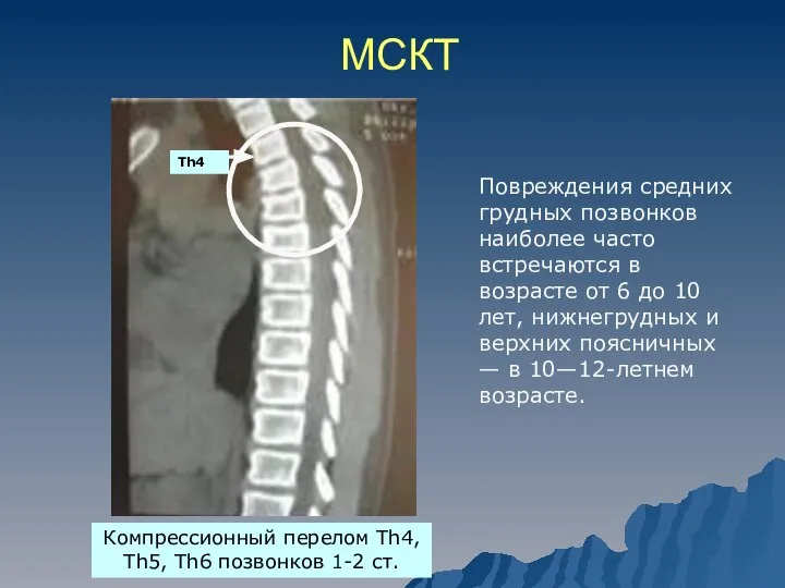 МСКТ Компрессионный перелом Th4, Th5, Th6 позвонков 1-2 ст. Повреждения средних