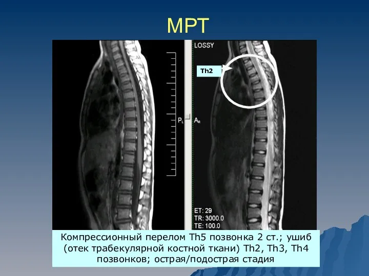 МРТ Компрессионный перелом Th5 позвонка 2 ст.; ушиб (отек трабекулярной костной