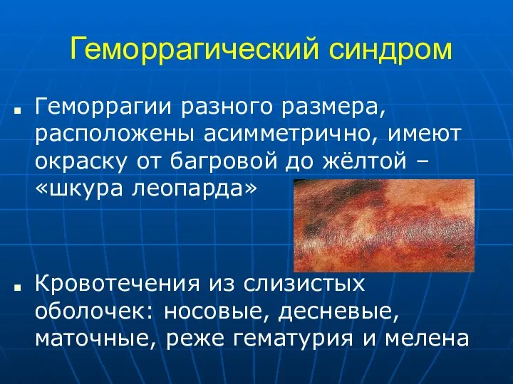 Геморрагический синдром Геморрагии разного размера, расположены асимметрично, имеют окраску от багровой