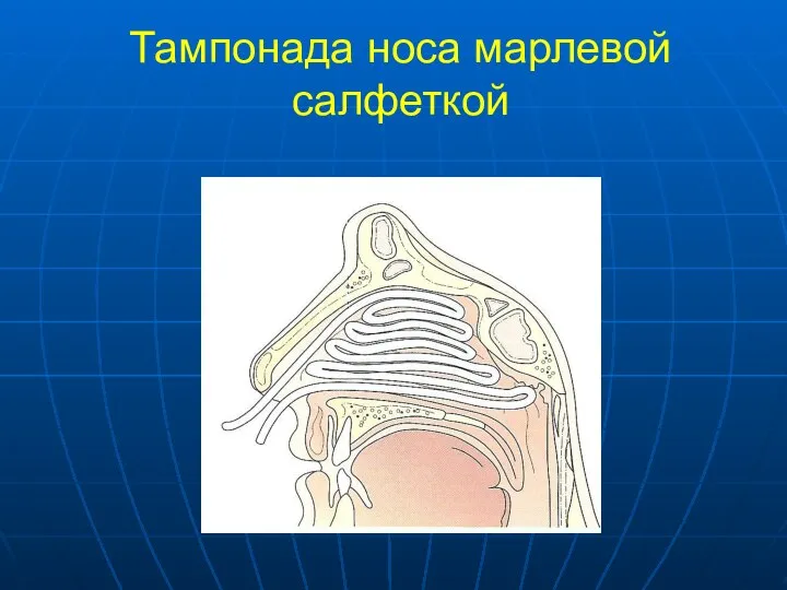 Тампонада носа марлевой салфеткой