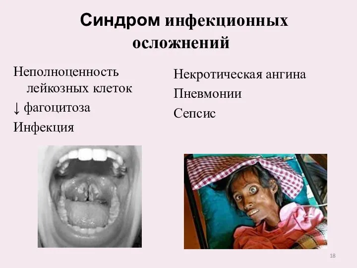 Неполноценность лейкозных клеток ↓ фагоцитоза Инфекция Синдром инфекционных осложнений Некротическая ангина Пневмонии Сепсис