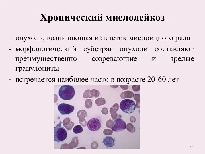 Хронический миелолейкоз опухоль, возникающая из клеток миелоидного ряда морфологический субстрат опухоли