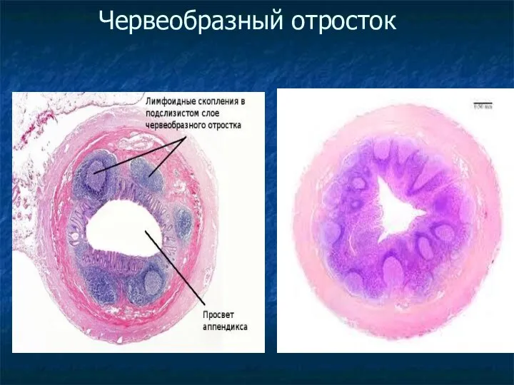 Червеобразный отросток