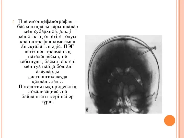 Пневмоэнцефалография – бас миындағы қарыншалар мен субархнойдальді кеңістіктің оттегіге толуы краниография