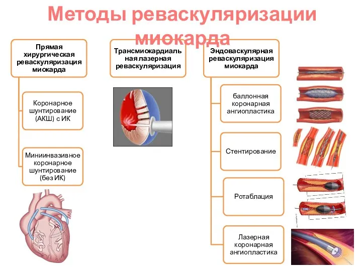 Методы реваскуляризации миокарда