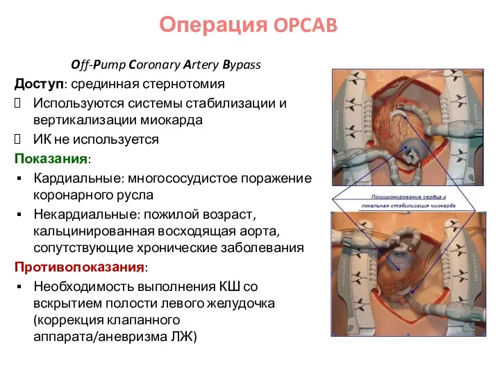 Off-Pump Coronary Artery Bypass Доступ: срединная стернотомия Используются системы стабилизации и