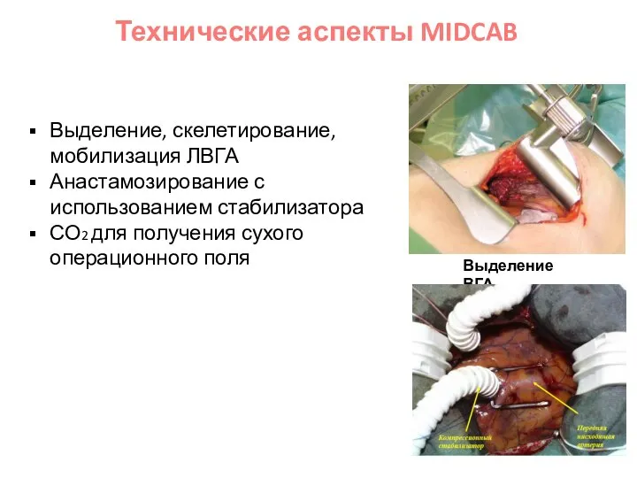 Выделение, скелетирование, мобилизация ЛВГА Анастамозирование с использованием стабилизатора СО2 для получения