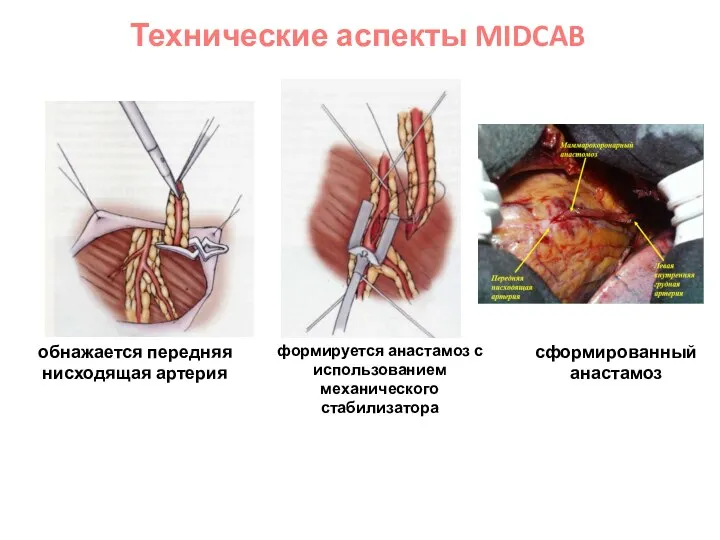 обнажается передняя нисходящая артерия формируется анастамоз с использованием механического стабилизатора сформированный анастамоз Технические аспекты MIDCAB