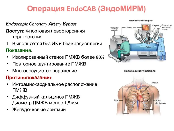 Endoscopic Coronary Artery Bypass Доступ: 4-портовая левосторонняя торакоскопия Выполняется без ИК