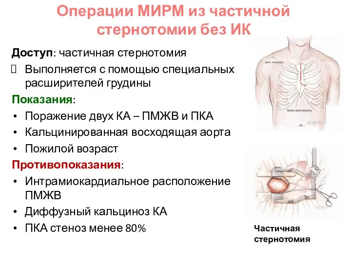 Доступ: частичная стернотомия Выполняется с помощью специальных расширителей грудины Показания: Поражение