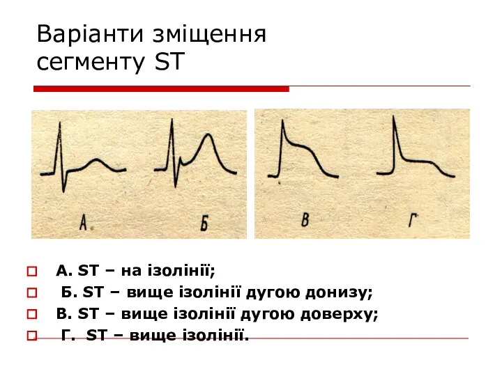 Варіанти зміщення сегменту ST А. ST – на ізолінії; Б. ST