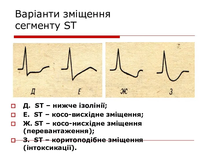 Варіанти зміщення сегменту ST Д. ST – нижче ізолінії; Е. ST