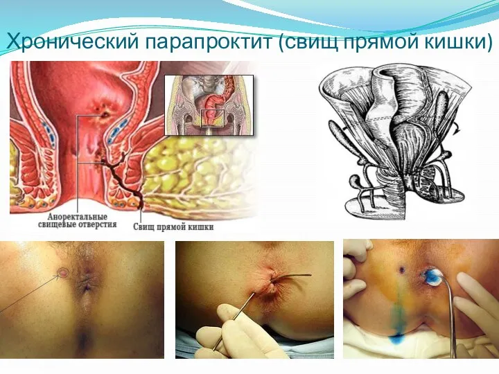 Хронический парапроктит (свищ прямой кишки)