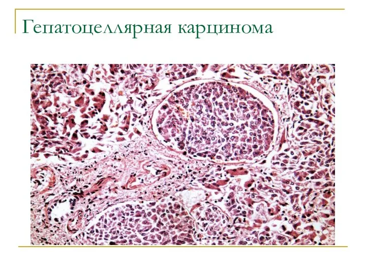 Гепатоцеллярная карцинома