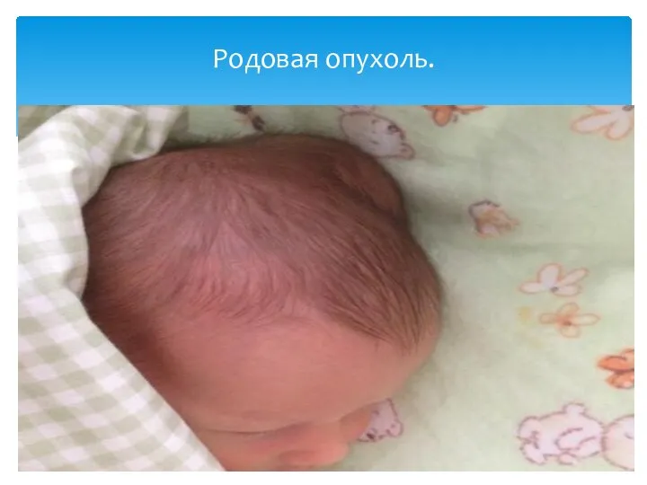 Родовая опухоль.