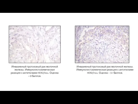 Инвазивный протоковый рак молочной железы. Иммуногистохимическая реакция с антителами HER2/neu. Оценка