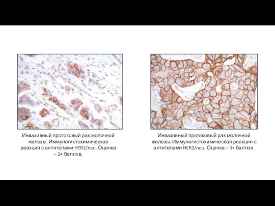 Инвазивный протоковый рак молочной железы. Иммуногистохимическая реакция с антителами HER2/neu. Оценка